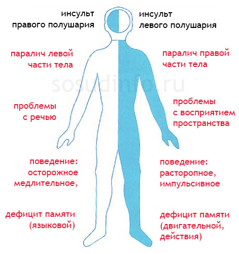 Транзиторная ишемическая атака причины признаки диагностика терапия прогноз tranzitornaya-ishemicheskaya-ataka-prichiny-priznaki-diagnostika-terapiya-prognoz-3