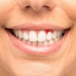5 причин получить результативное лечение десен в стоматологии Татьяны Коновой
