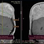 Опухоль головы больших размеров удалена в нейрохирургическом отделении Херсонской областной больницы