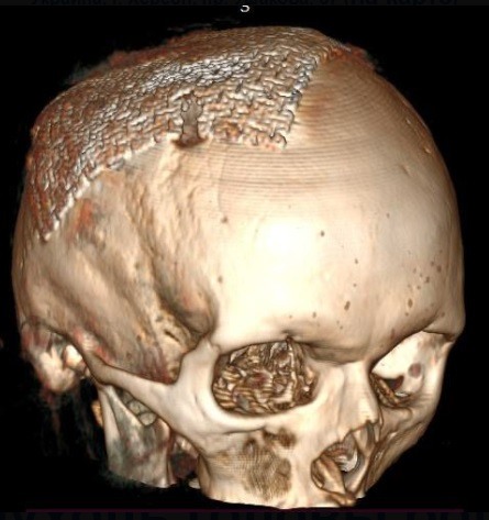 Опухоль головы больших размеров удалена в нейрохирургическом отделении Херсонской областной больницы