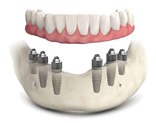 Имплантация зубов как способ восстановления ваших зубов