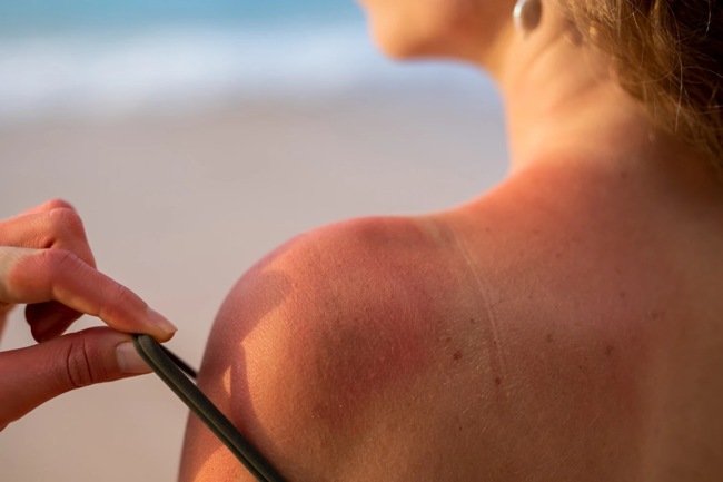 Аллергия на солнце: причины симптомы и методы защиты