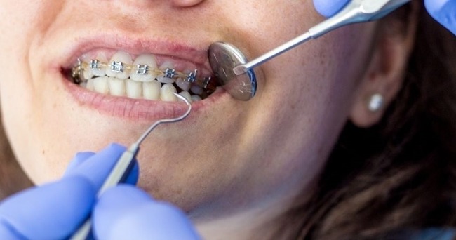 Встановлення брекет-систем: шлях до ідеальної усмішки